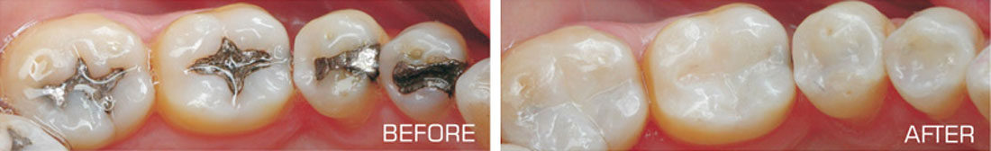 White-Fillings
