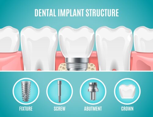 Placing Your Implants – The Procedure Dental implants