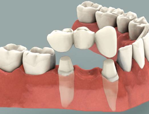 Dental bridges: The Pros and Cons of a Common Tooth Replacement Procedure