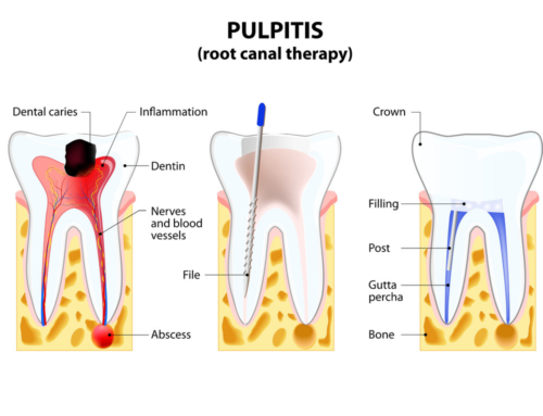Root Canal Treatment – A Compelling Method for Saving Tainted Teeth