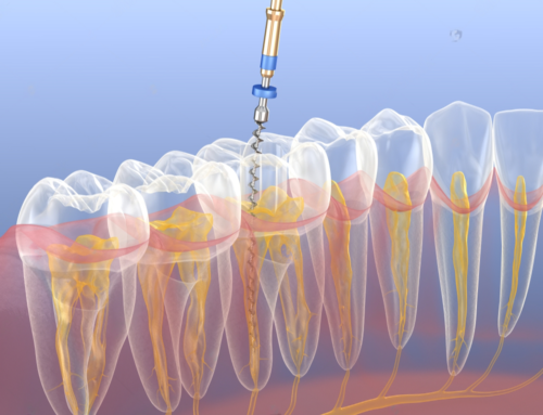 Root Canal Treatment: Everything You Need to Know