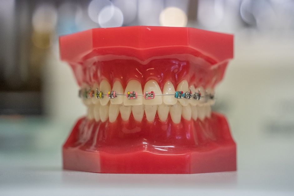 pexels-photo-19328507-19328507 Model of human teeth with colorful braces, showcasing dental care and orthodontics.